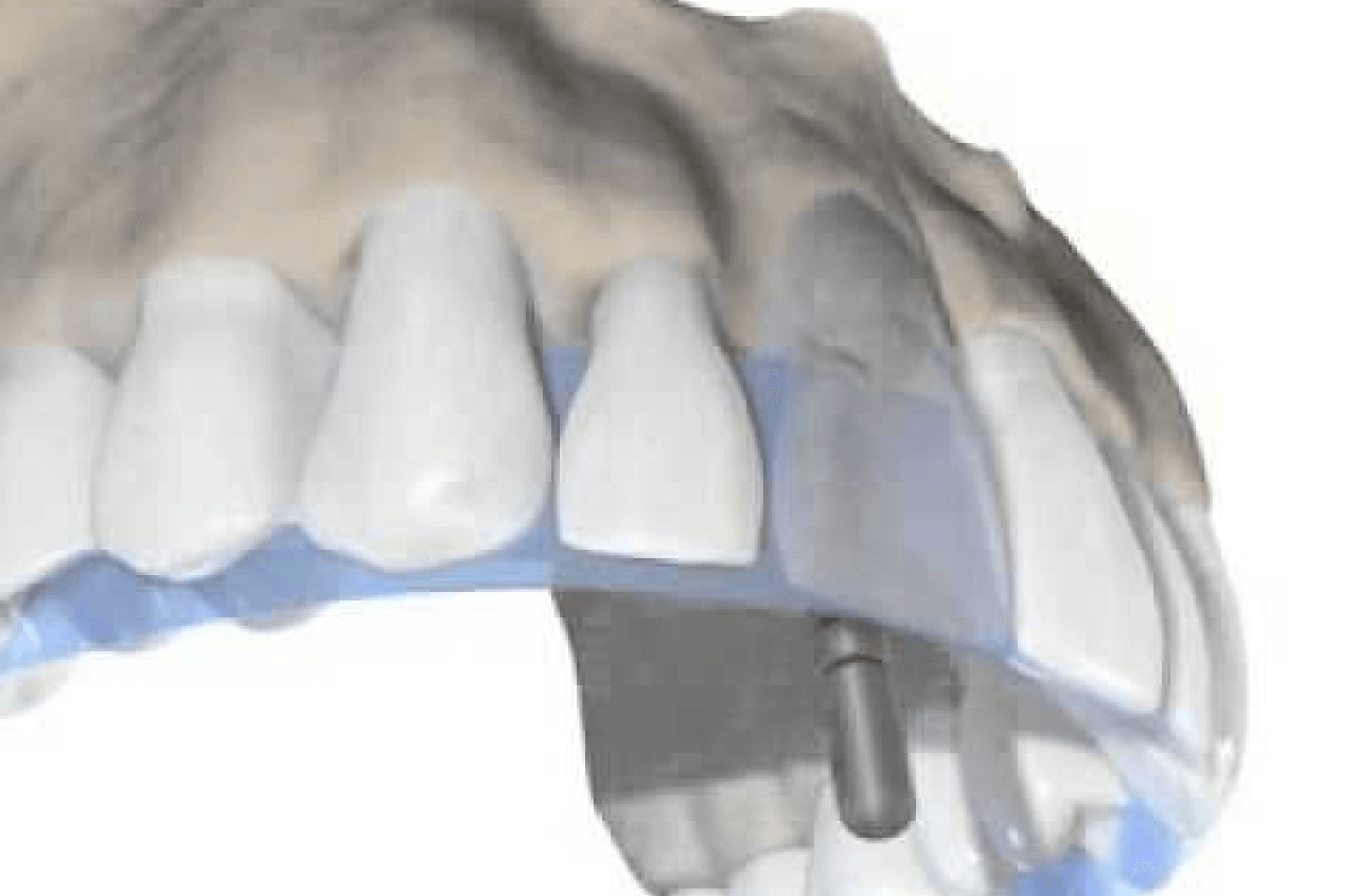 Dental Implant Treatment in Birmingham Placement - Cadbury Dental