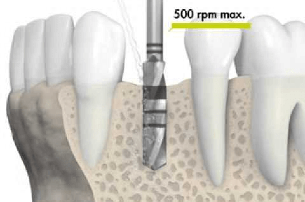 Premolar Dental Implant in Birmingham Placement Thumbnail - Cadbury Dental 
